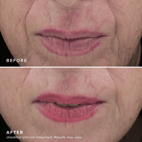 Needle-less® Serum